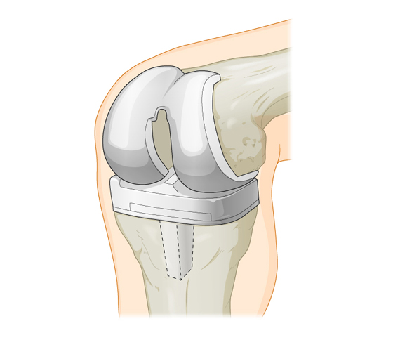 Протезирование коленного сустава сколько заживает. Эндопротезирование коленного сустава. Эндопротез коленного сустава. Артропластика коленного сустава. Схема операции эндопротезирования коленного сустава.