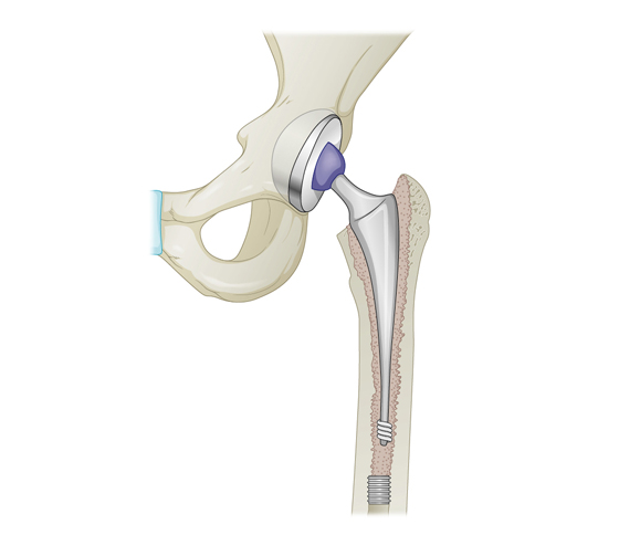 Hip joint replacement