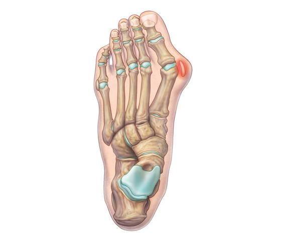 ‘high-heel disease’, big toe deviated toward the smaller toes