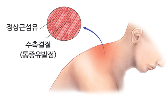 수원근육통, 담낭, 근막통증후군 원인 및 치료